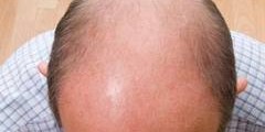 head-hair