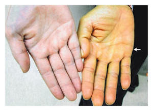 jaundice