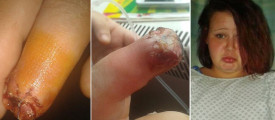 False-nail-glue-rotted