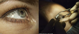 Platinum-Jewelry-Implanted-in-Womans-Eye