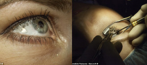 Platinum-Jewelry-Implanted-in-Womans-Eye