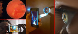 Smartphone-takes-photos-of-retina