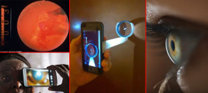 Smartphone-takes-photos-of-retina