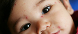 chicken-pox