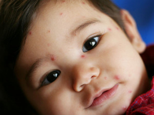 chicken-pox