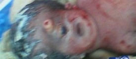 one-eye-baby-born-with-penis-on-head